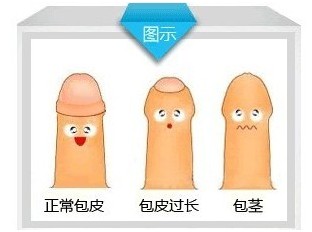 包皮包茎 (2).jpg